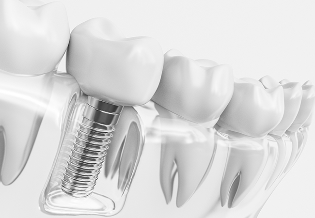 インプラント治療