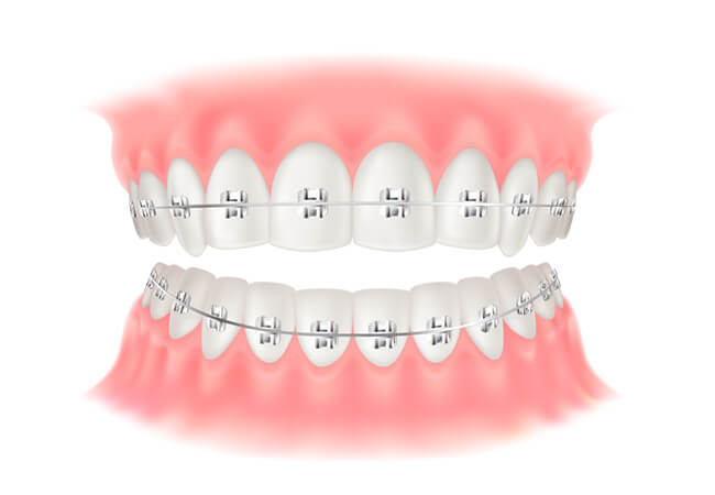 ワイヤー矯正（表側矯正）