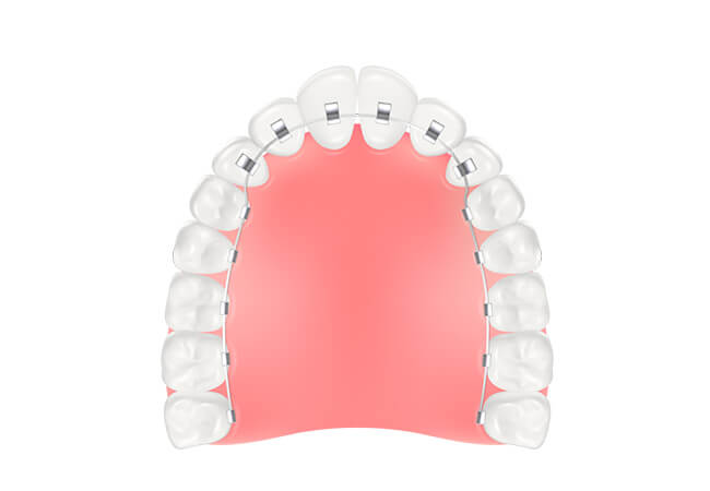 舌側矯正（裏側矯正）