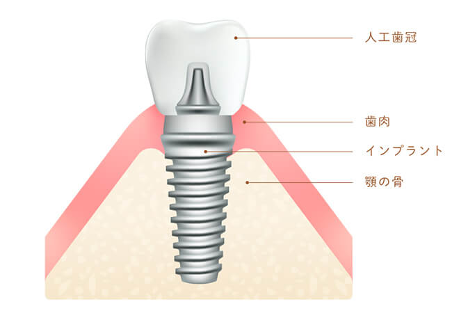 インプラント構造
