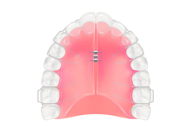 床矯正（取り外し式）