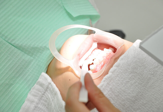 オフィスホワイトニング（医院で行う）