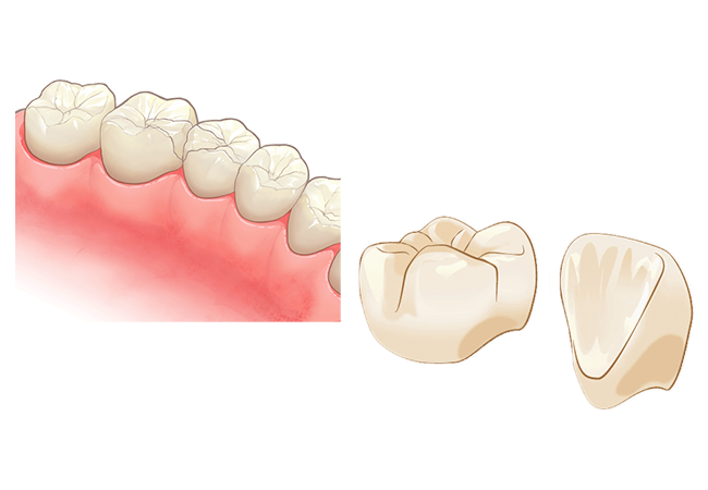 セラミックのつめ物・かぶせ物