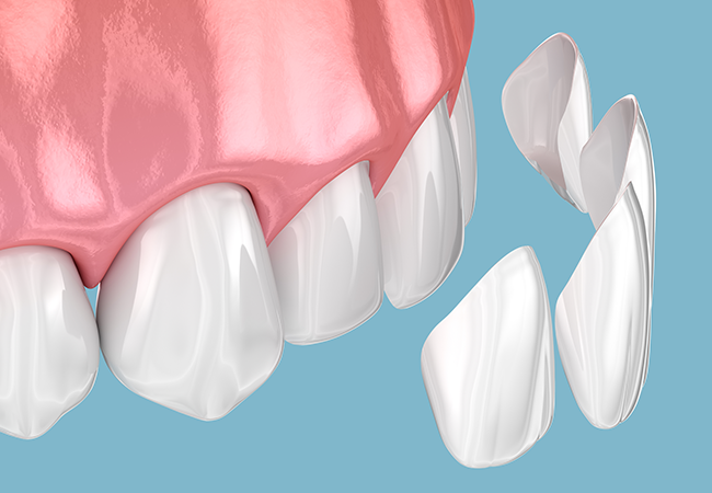 ラミネートベニア