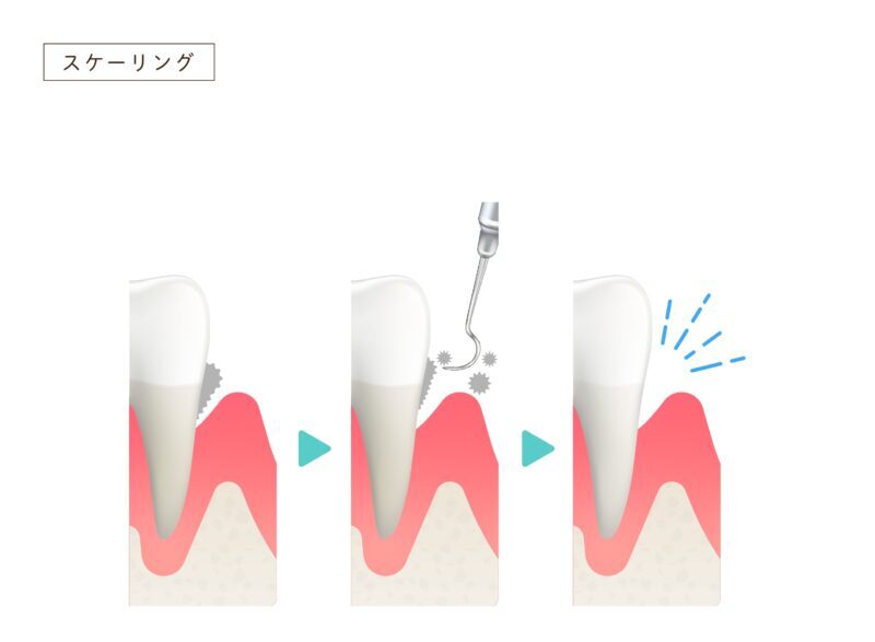 スケーリング